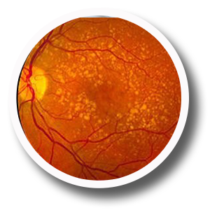 Macula de ojo en una Tomografia de ojo